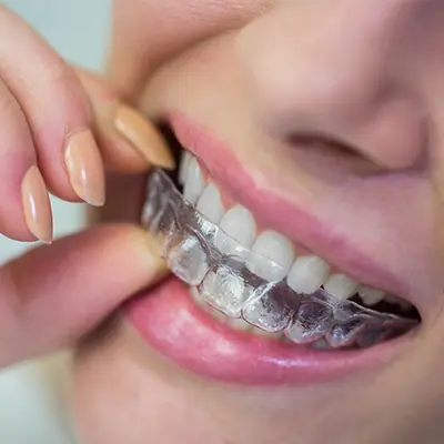 foto ilustrativa Alinhador Ortodôntico